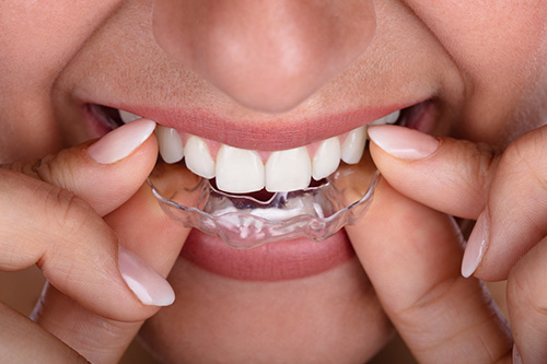 Clear Aligner Therapy Special Promo